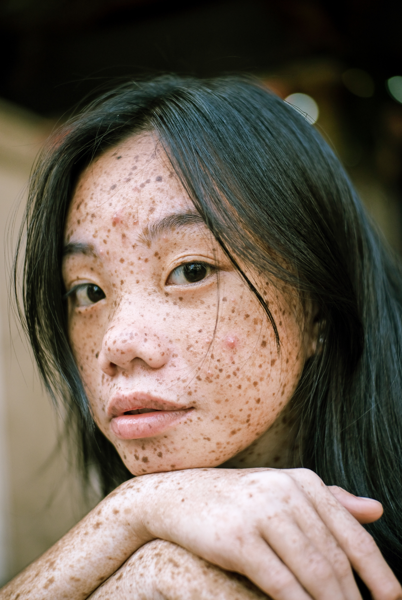 Freckles Removal