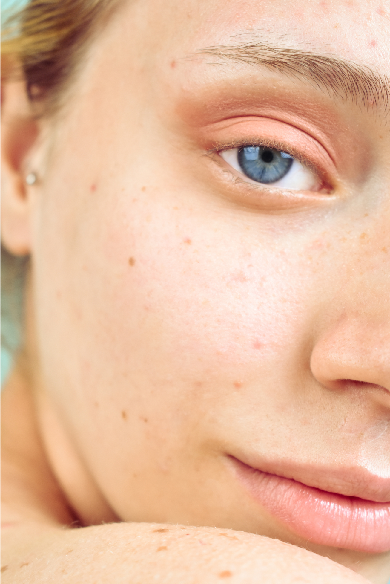 Freckles Removal Vancouver